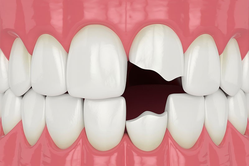 3d model of cracked tooth