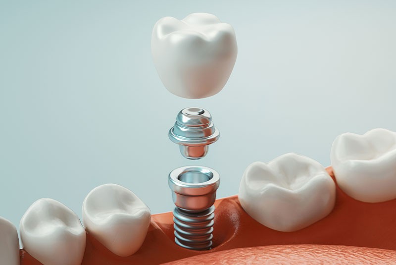 Dental Implants Service Lake Oswego OR