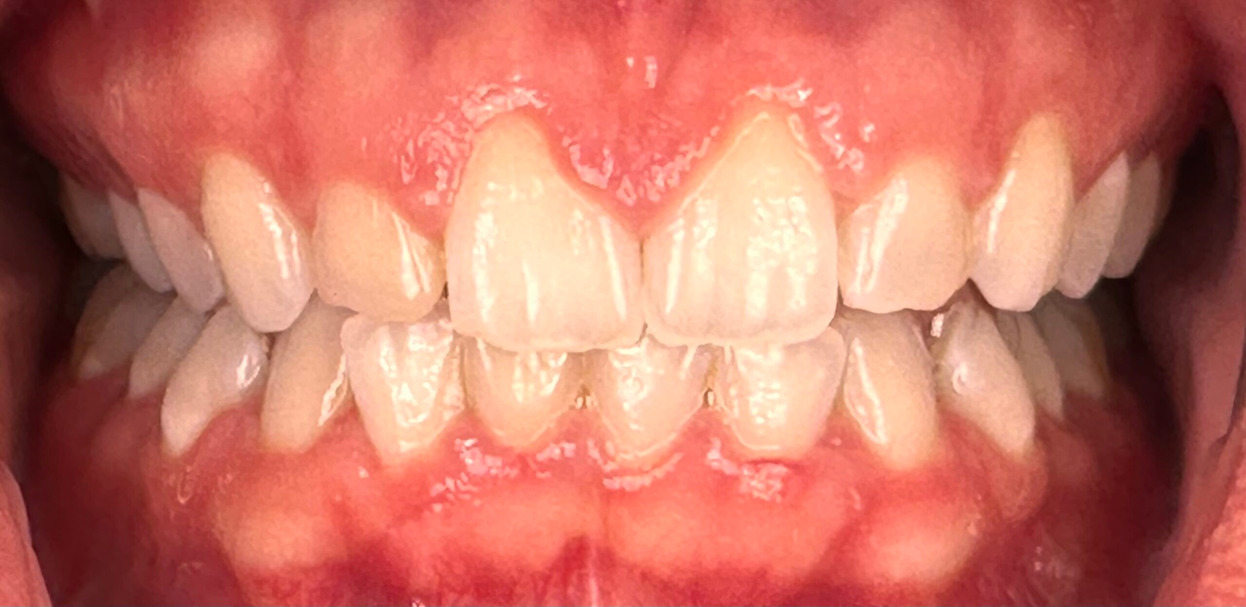 Transforming a Gummy Smile with Crown Lengthening: A Case Study