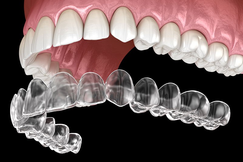 Clear aligners 3d model