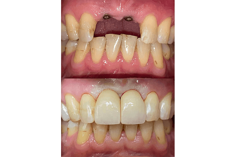 before and after dental implant procedure