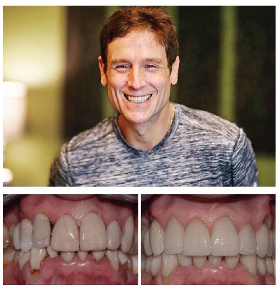 james - dental implant patient