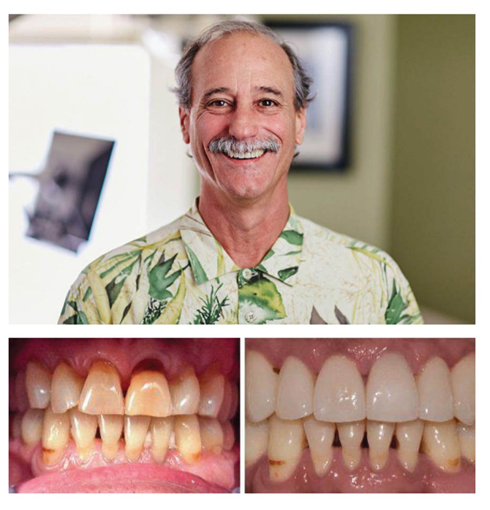 Tom - dental implants patient